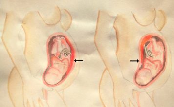 Anterior Placenta vs. Posterior Placenta
