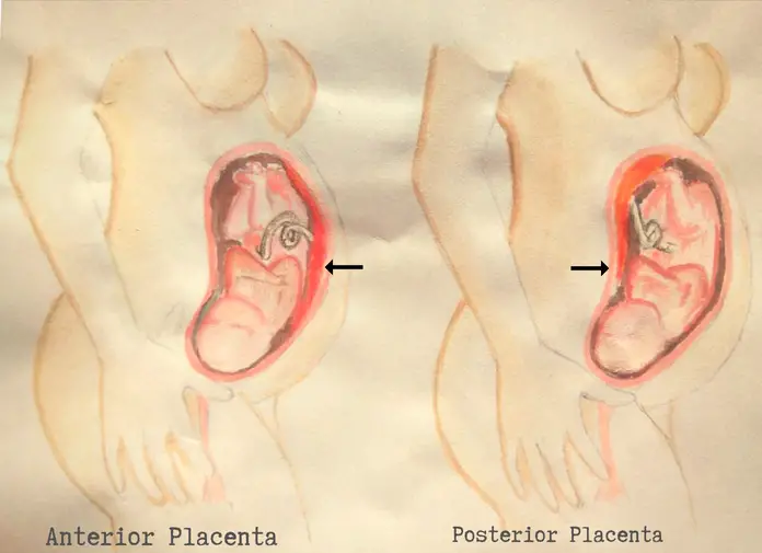 Anterior Placenta vs. Posterior Placenta