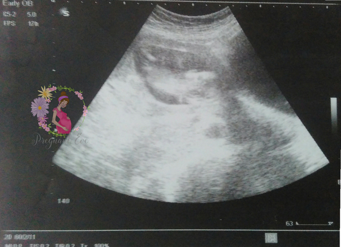 12 Weeks Ultrasound Pictures